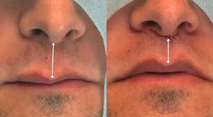 Lip Lift amplia opções de rejuvenescimento sem volume