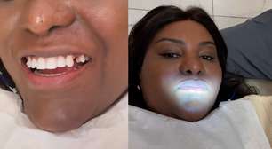 Ex-Rouge quebra dente comendo bacalhau e corre para consertar: 'Usar bastante essa boca no carnaval'