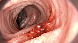 Câncer de cólon: a nova ameaça mortal entre jovens adultos