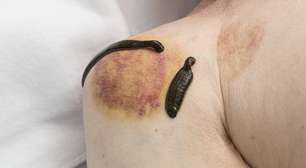 As sanguessugas funcionam mesmo na medicina?