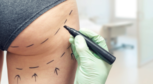 Por que Reino Unido faz ofensiva contra o 'Brazilian butt lift', procedimento para aumentar o bumbum