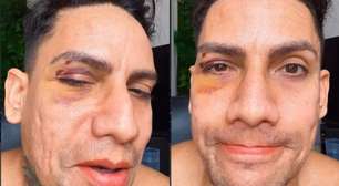 Arquiteto é xingado e agredido no carnaval de Olinda: 'Isso aqui no meu rosto é marca da homofobia'