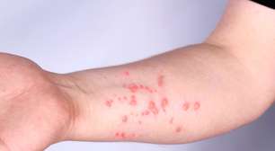 Brasil registra 47 casos do vírus Mpox e Ministério da Saúde faz pronunciamento importante