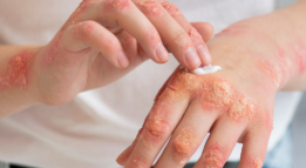 Mpox no Brasil: doença pode matar? Conheça os sintomas