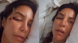 Ivete Sangalo mostra rosto com ferimentos após desmaiar em casa; cantora está internada em Salvador