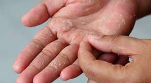 Psoríase: o que é mito e o que é verdade após diagnóstico da filha de Pocah