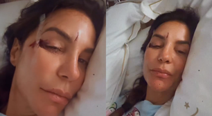 Ivete Sangalo é internada e mostra rosto machucado