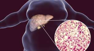 Jejum intermitente pode reduzir a gordura no fígado? O que dizem os estudos científicos