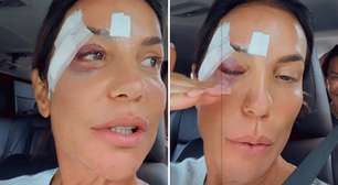 Ivete Sangalo surge com o rosto cheio de hematomas após internação: 'É difícil'