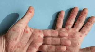 Surto de mpox: saiba como identificar os sintomas