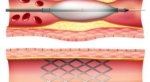O que é cateterismo? Procedimento feito em Herson Capri após infarto