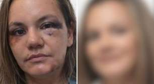 Mulher que sofreu 60 socos passa por reconstrução facial e especialista alerta: 'Múltiplos impactos'