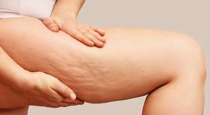 Por que a celulite ainda é ligada a pessoas obesas? Especialista explica