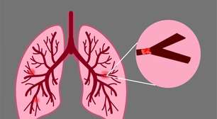 Embolia pulmonar: conheça os sintomas e os fatores de risco da doença