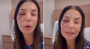 VÍDEO: Ivete Sangalo detalha cirurgia facial após acidente doméstico: 'Quebrei dois ossos'