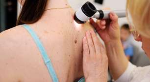 Câncer de pele: 11 mitos que atrasam o diagnóstico, alerta dermatologista