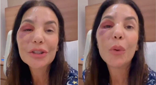 É grave? Ivete Sangalo precisa passar por cirurgia no rosto