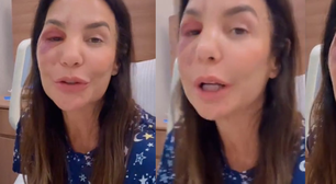 O que aconteceu com Ivete Sangalo? Cantora quebra dois ossos do rosto após desmaio, passa por cirurgia e surge inchada nas redes: 'Estou bem'