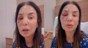 Ivete Sangalo comenta cirurgia no rosto após queda no banheiro: 'Quebrei dois ossos'