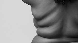 Obesidade avança e especialistas alertam para impactos na saúde