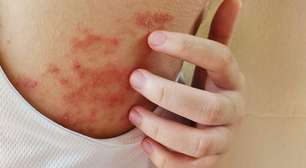 Pele atópica: 6 cuidados que ajudam a reduzir coceira e irritação