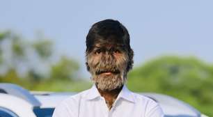 Jovem com 'síndrome do lobisomem' conta detalhes sobre rotina