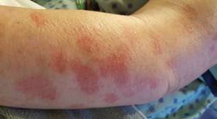 Hanseníase: entenda causas, sintomas e tratamento da doença