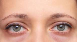 Nem sempre é cansaço: 8 motivos por trás das pálpebras inchadas