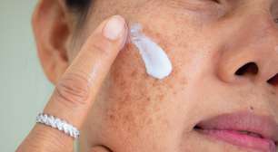 Melasma tem cura? Veja o que realmente funciona no tratamento