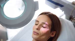 O que causa vasinhos no rosto? 8 motivos que afetam a estética