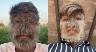 'Síndrome do lobisomem': recordista com rosto mais peludo do mundo vira influencer e expõe rotina rara