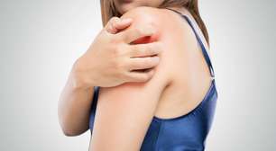 Tudo sobre a micose de pele: sintomas, tratamento e cura