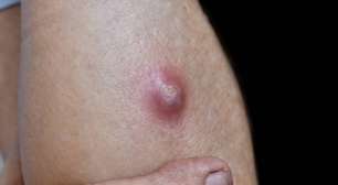 Por que surgem furúnculos: como evitar e tratar?