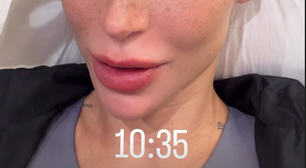 Transplante de sobrancelha: Bianca Andrade detalha procedimento