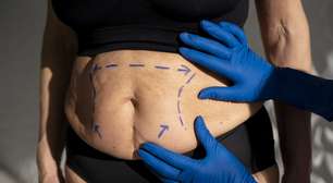 Mommy makeover: quando fazer procedimentos após a gravidez?