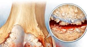 Artrose: o que é a doença que afeta articulações e impõe limites incômodos no dia a dia