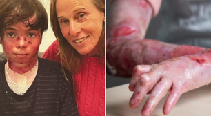 O que é epidermólise bolhosa, condição que vitimou neto de coreógrafa aos 14 anos