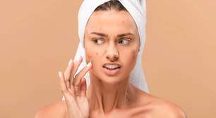Da pele ao tratamento: estratégias para combater a acne de forma segura