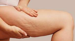 Dieta anticelulite funciona? Veja o que realmente muda na pele