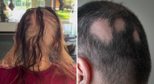 Alopecia: entenda a condição que afeta homens e mulheres