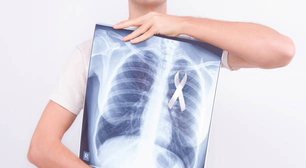 Diretrizes atuais estão falhando no rastreamento de pacientes com câncer de pulmão