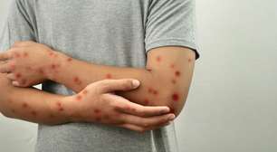 Ceará confirma terceiro caso de Mpox este ano