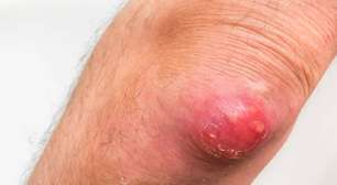 Furúnculo na pele: sintomas, riscos e sinais de alerta