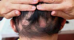 O que causa alopecia? Veja os principais fatores por trás da queda capilar