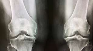 Dois irmãos, uma condição hereditária rara e uma corrida contra o tempo por tratamento