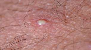 Por que o corpo produz o pus?