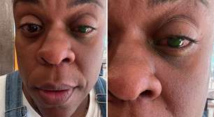 Cega? Cacau Protásio tem perda de visão após usar produto: 'Dor desesperadora'