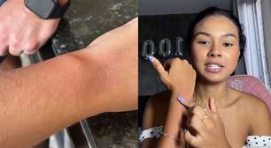 Fãs de Luan Santana relatam queimaduras após uso de pulseiras em show em BH: 'Ardeu muito'