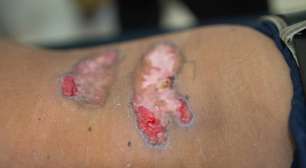 Entenda a erisipela: causas, sintomas e riscos da infecção bacteriana