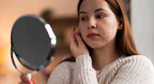 Acne adulta ou rosácea? Saiba a diferença!